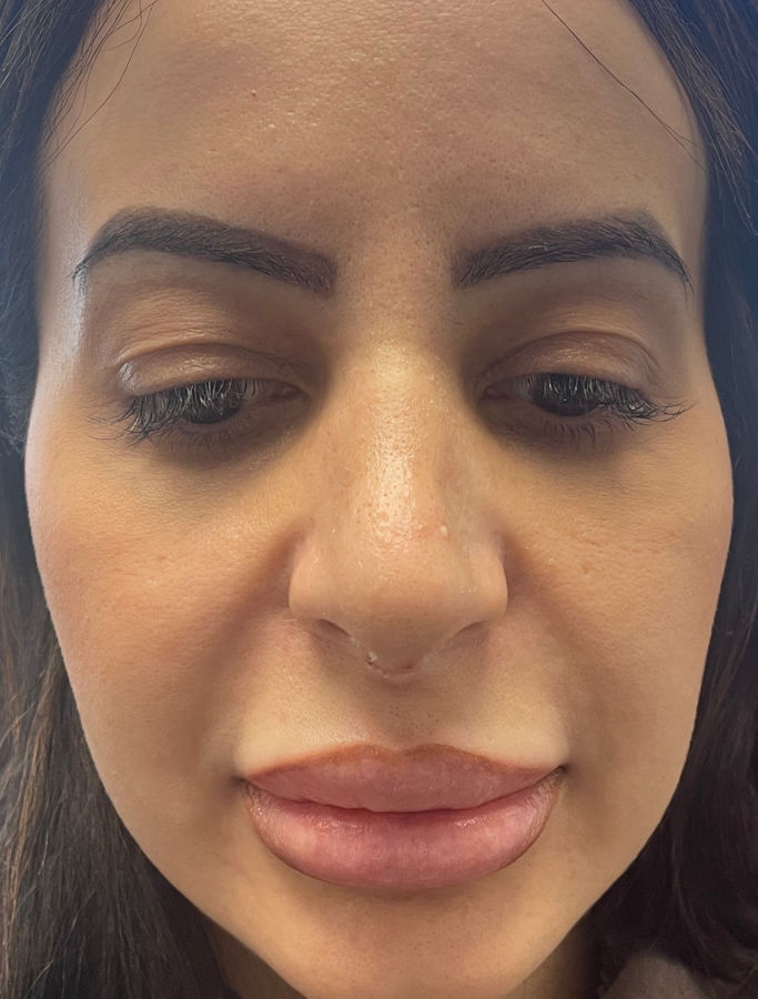 After Image: Patient Case #1671 - front