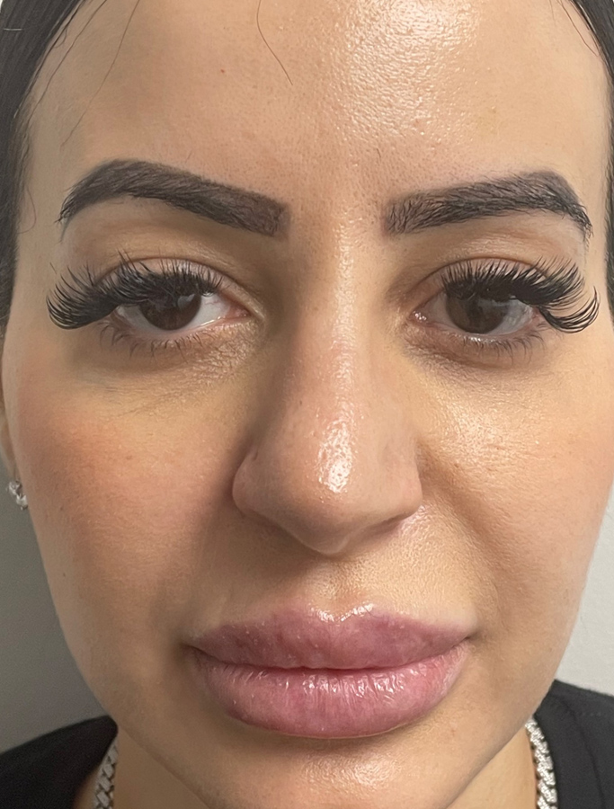 Before Image: Patient Case #1671 - front