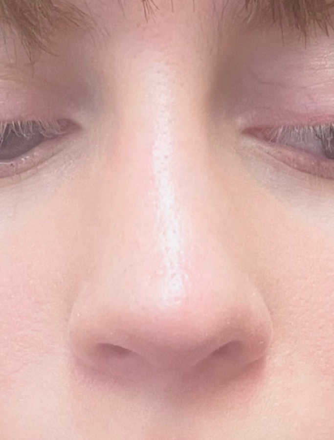 After Image: Patient Case #1674 - front