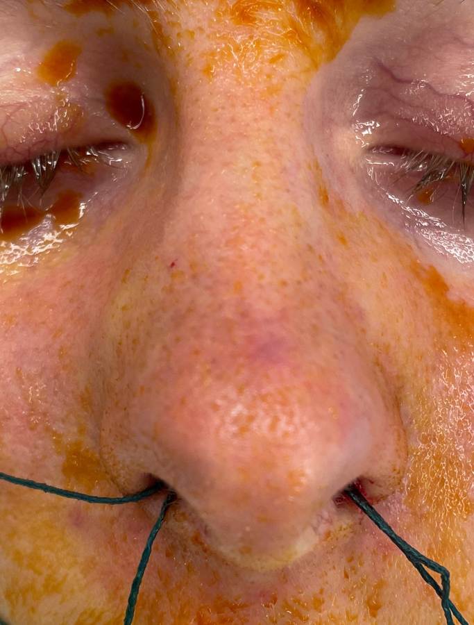 Before Image: Patient Case #1674 - front