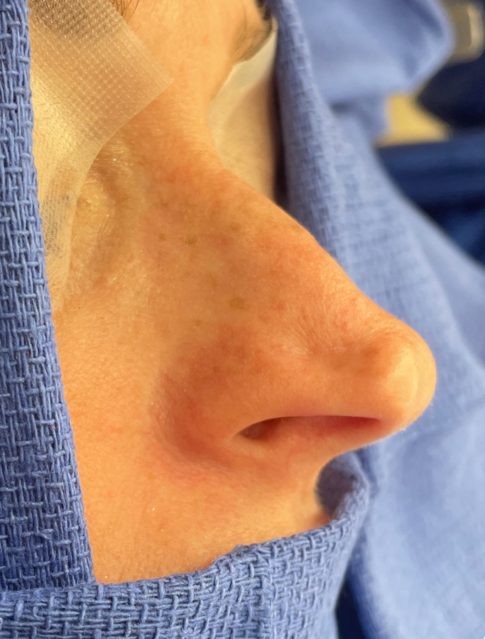 Before Image: Patient Case #1675 - right-side