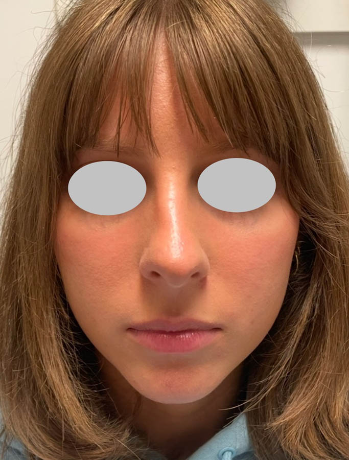 Before Image: Patient Case #18129 - front