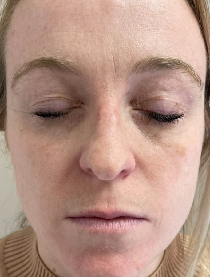 Before Image: Patient Case #18132 - front