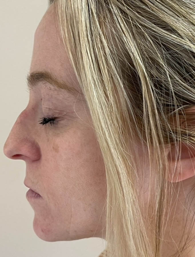 Before Image: Patient Case #18132 - left-side