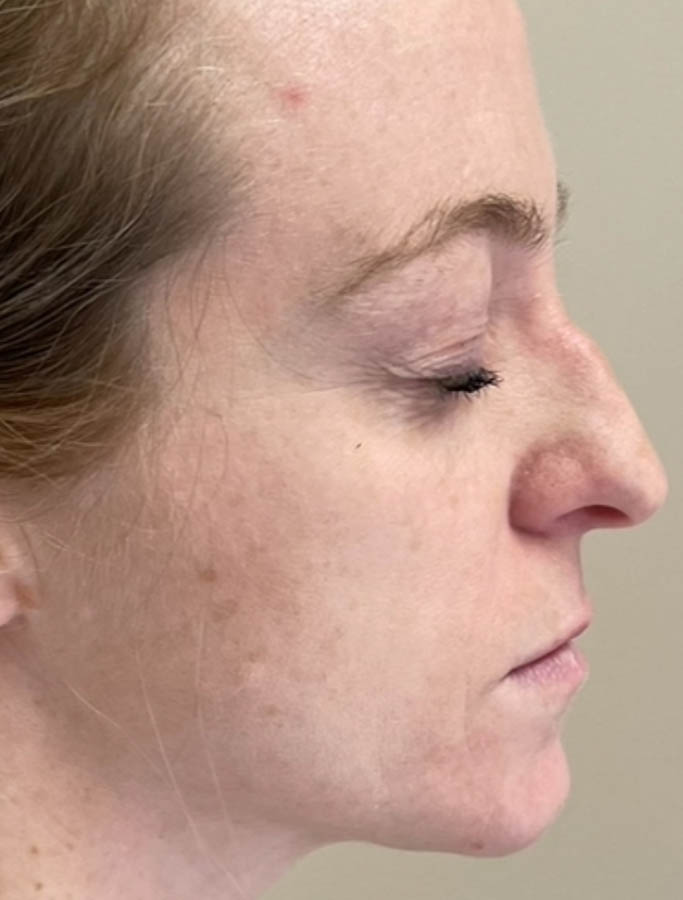 Before Image: Patient Case #18132 - right-side