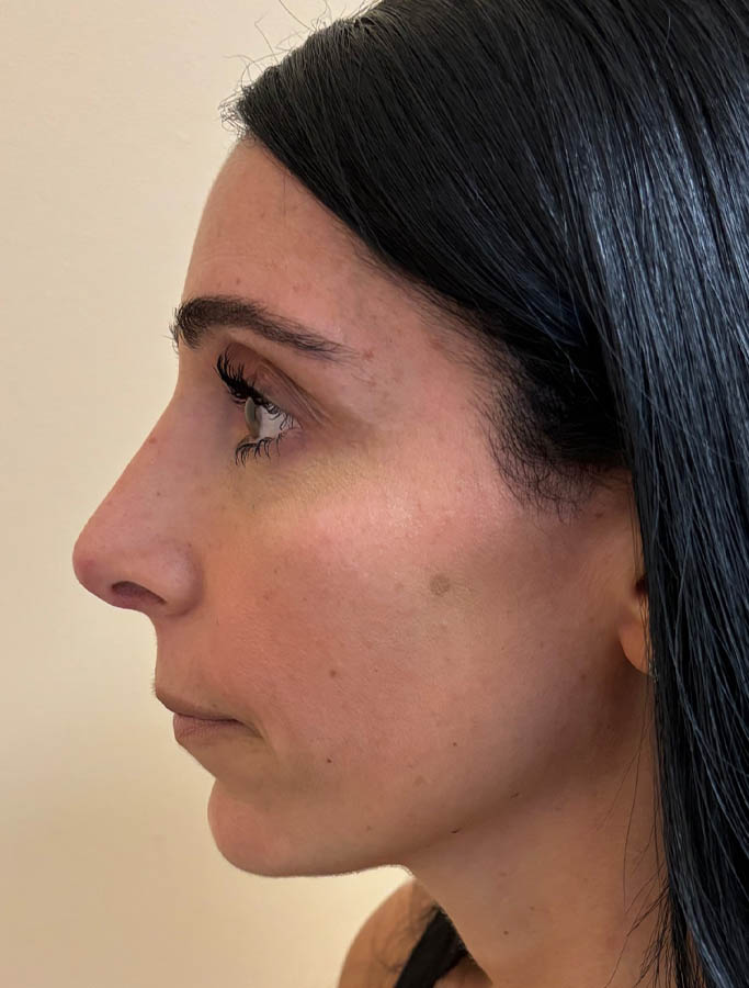 After Image: Patient Case #18139 - left-side