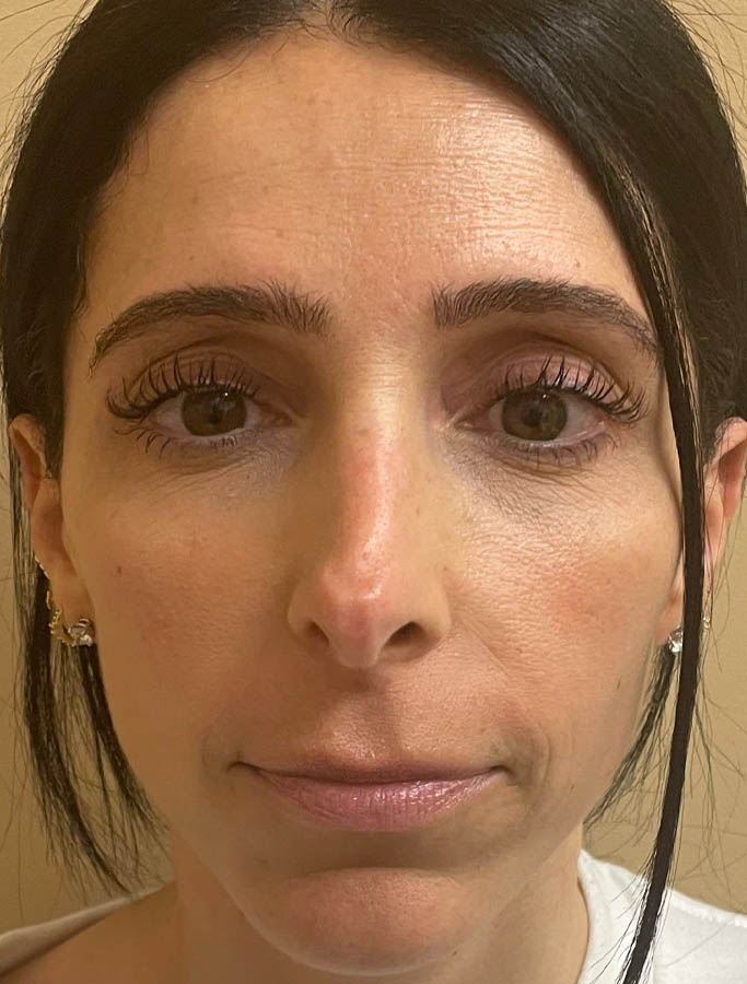 Before Image: Patient Case #18139 - front