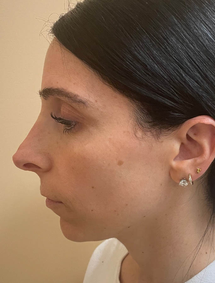 Before Image: Patient Case #18139 - left-side