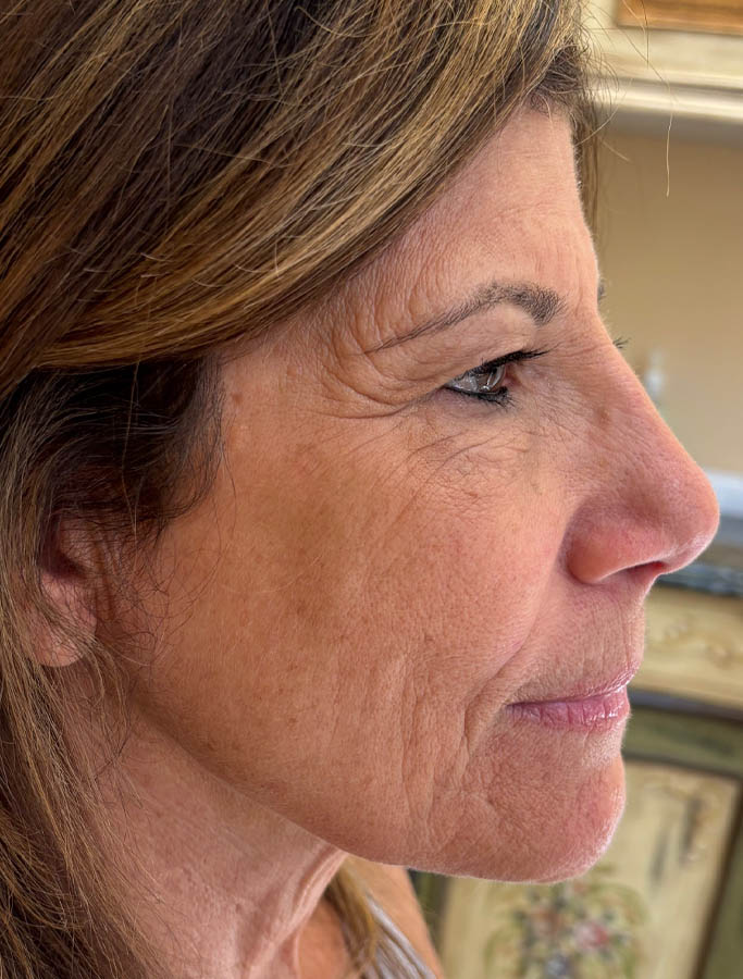 After Image: Patient Case #18146 - right-side