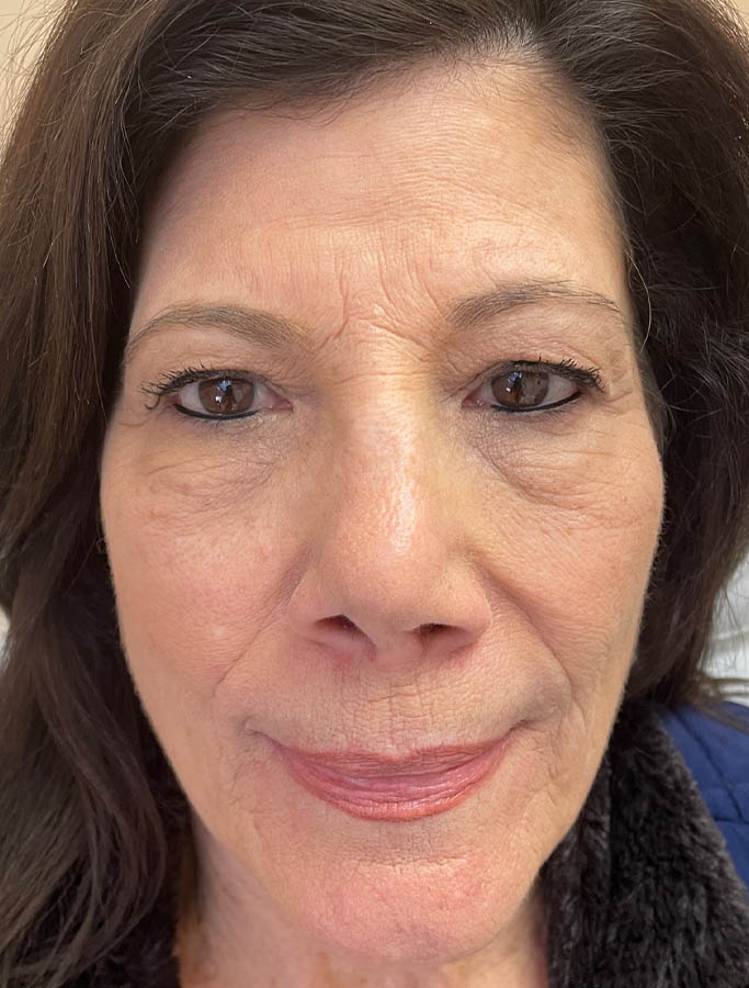 Before Image: Patient Case #18146 - front