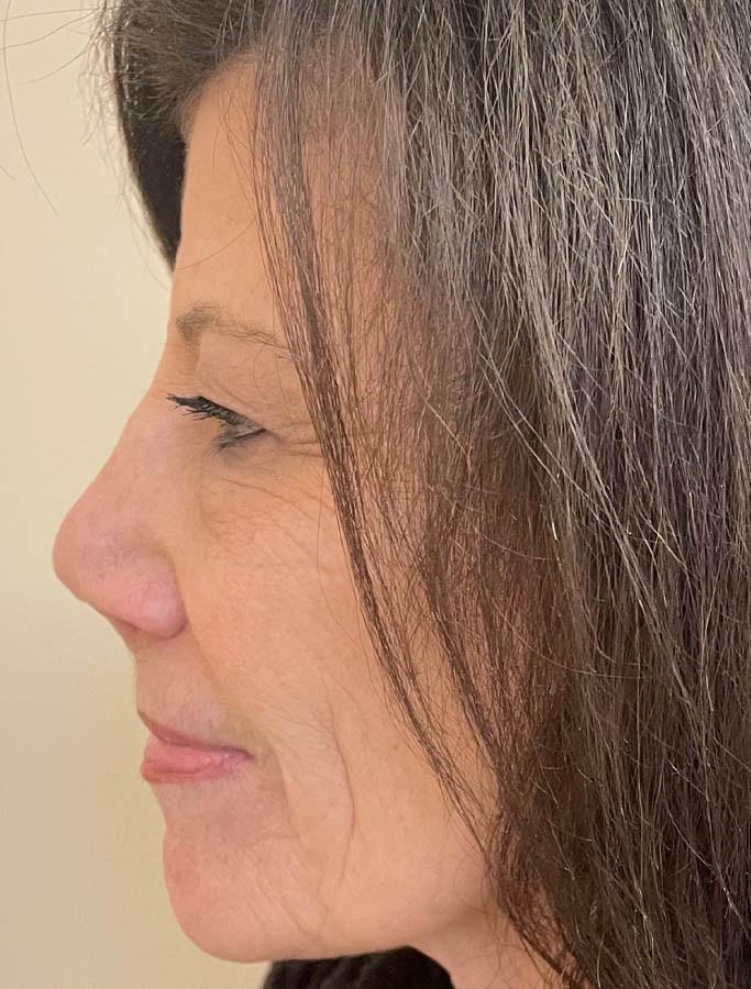 Before Image: Patient Case #18146 - left-side