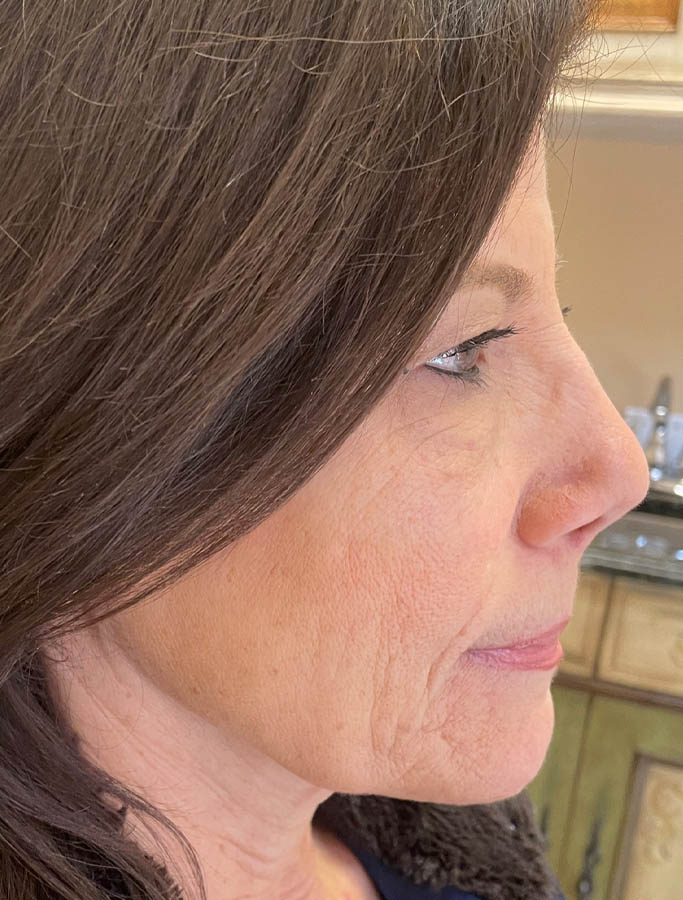 Before Image: Patient Case #18146 - right-side