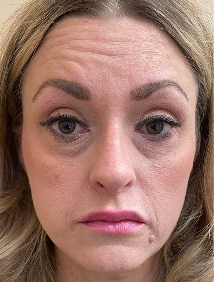 After Image: Patient Case #18153 - front