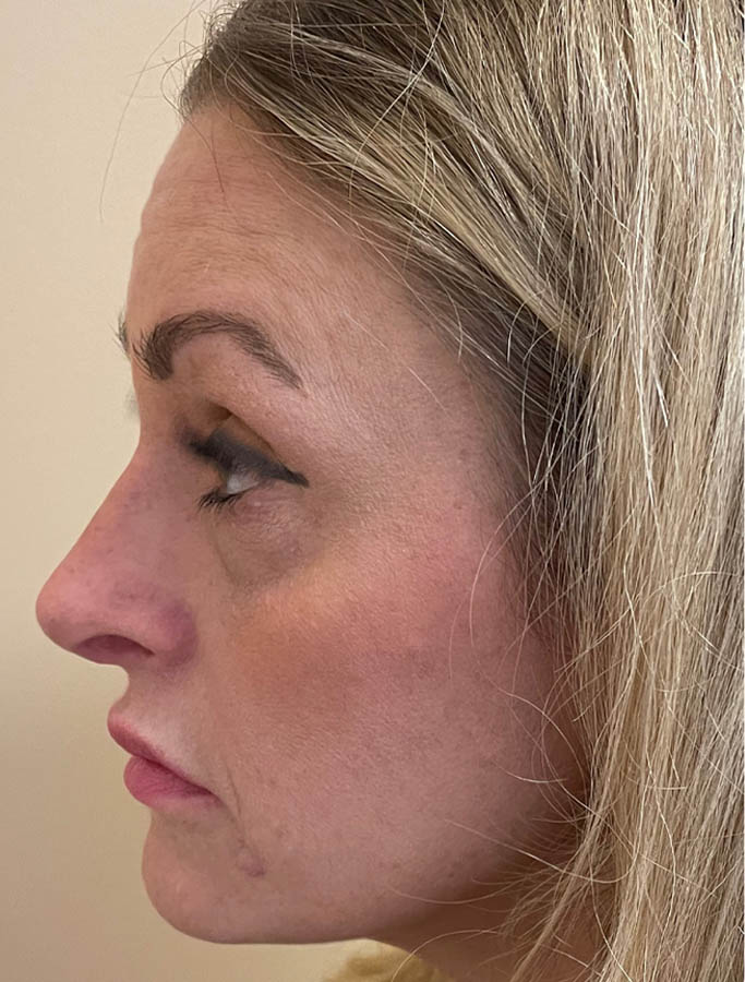 After Image: Patient Case #18153 - left-side