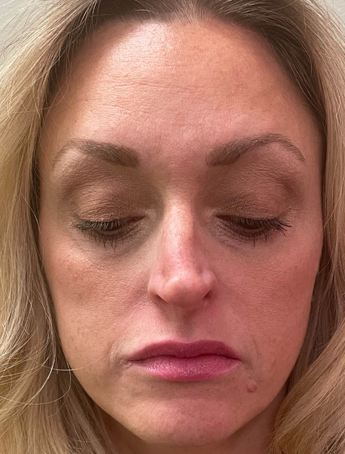 Before Image: Patient Case #18153 - front