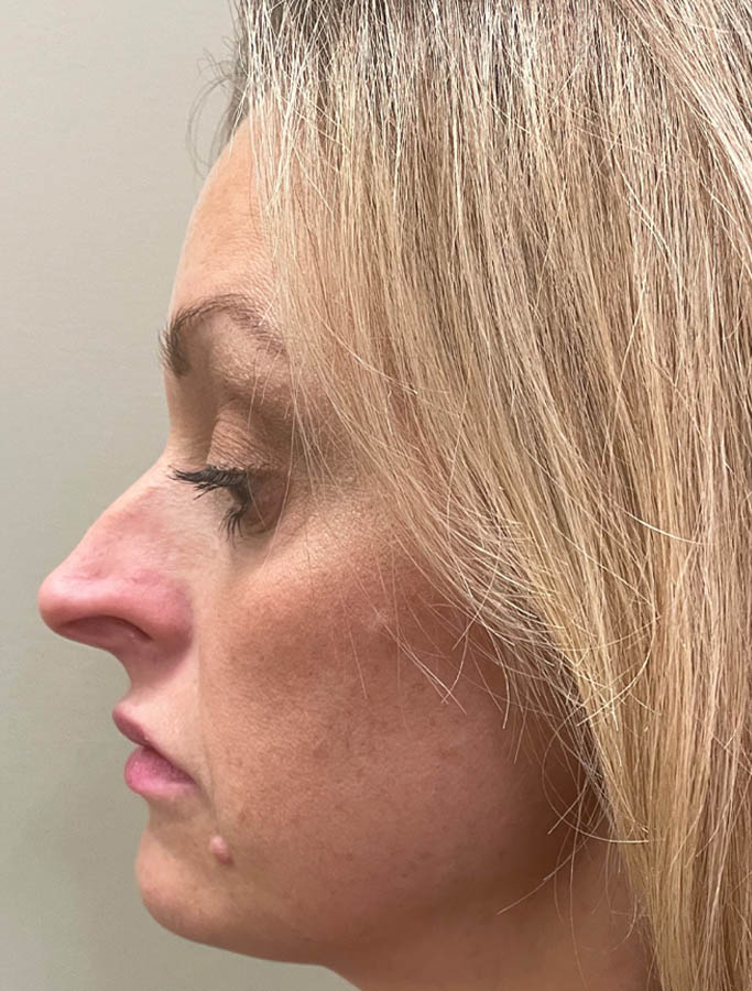 Before Image: Patient Case #18153 - left-side