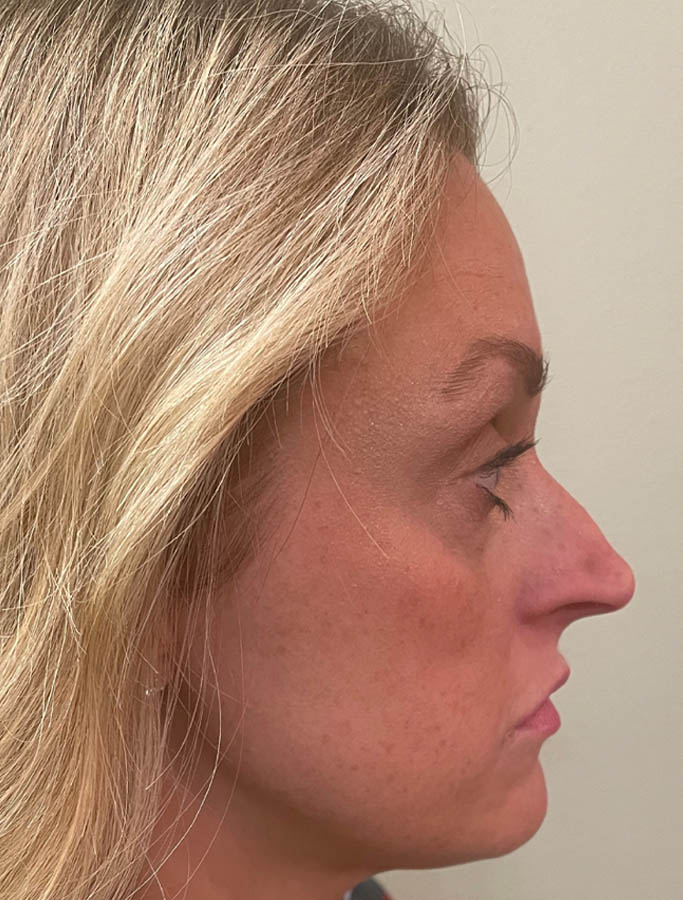 Before Image: Patient Case #18153 - right-side