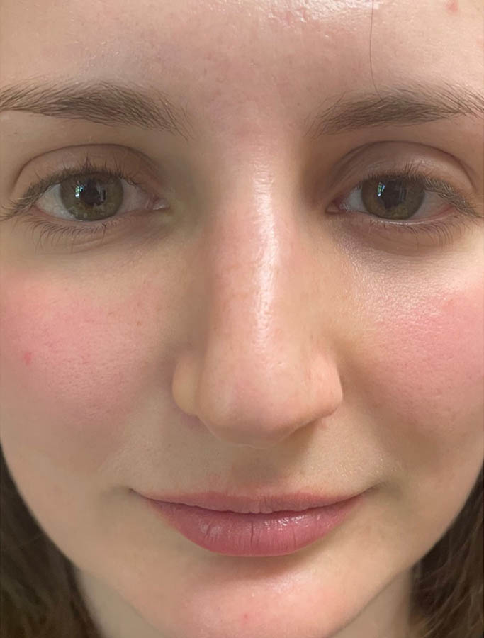 Before Image: Patient Case #18165 - front