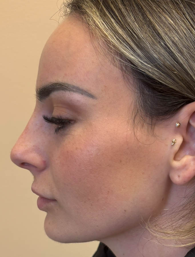 After Image: Patient Case #18648 - left-side