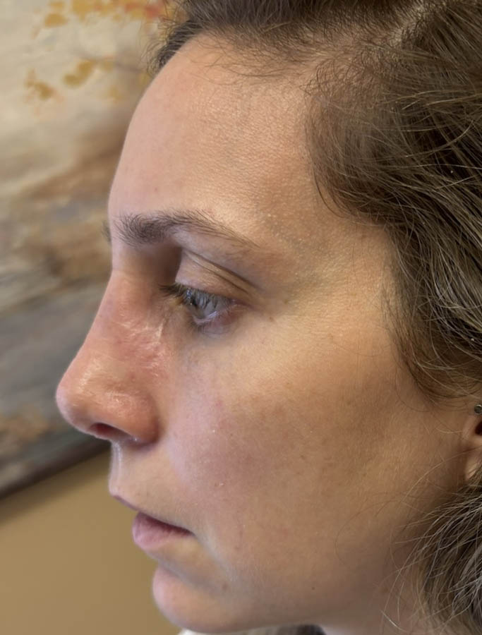 After Image: Patient Case #18655 - left-side