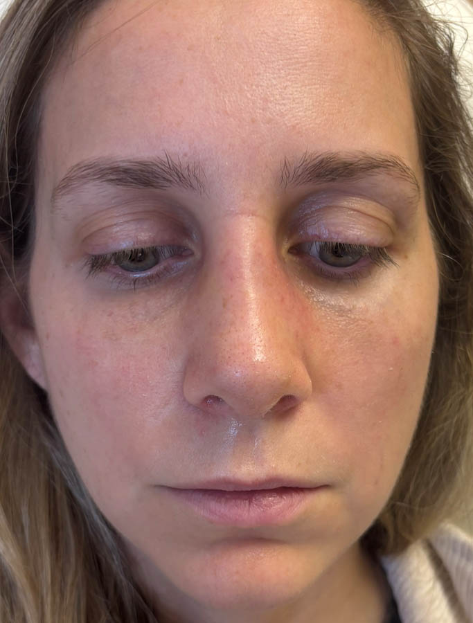 After Image: Patient Case #18655 - front