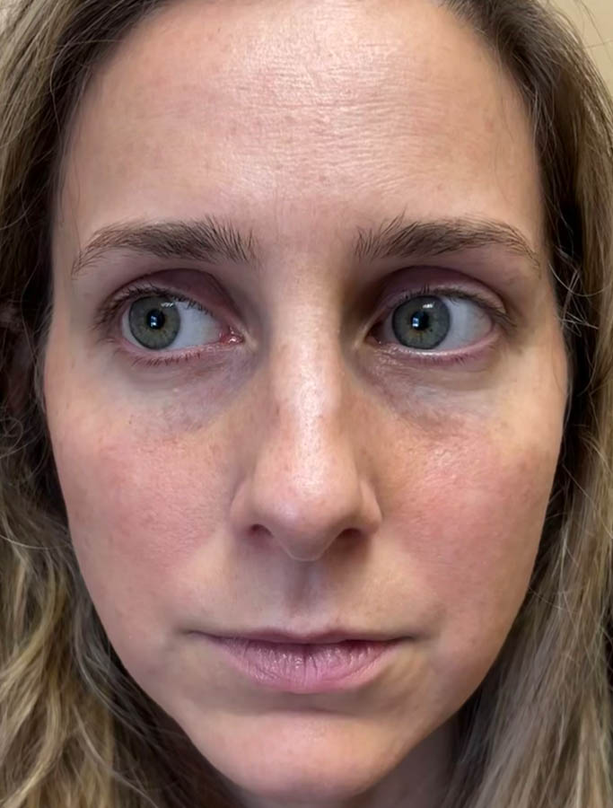 Before Image: Patient Case #18655 - front