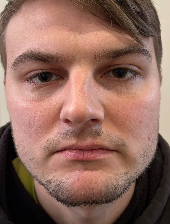 Before Image: Patient Case #18666 - front