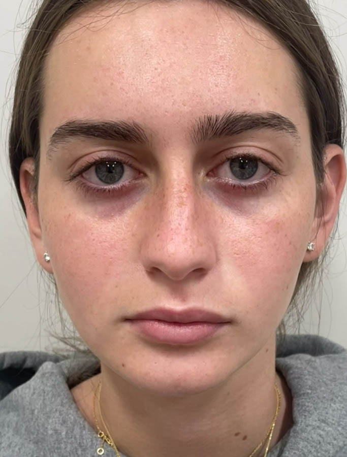 Before Image: Patient Case #18669 - front