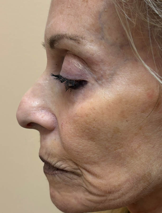 Before Image: Patient Case #18682 - left-side