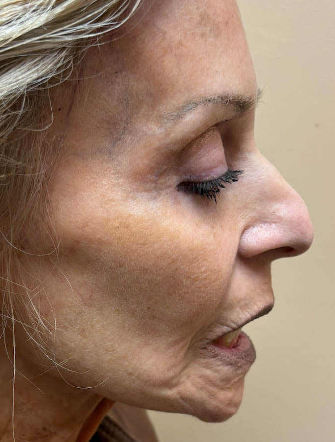 Before Image: Patient Case #18682 - right-side