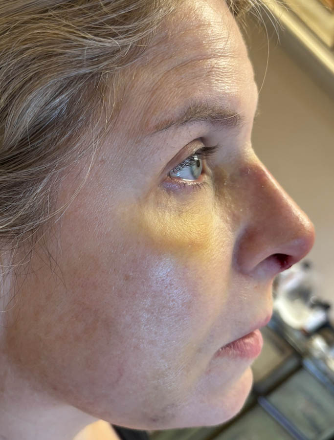 After Image: Patient Case #18687 - right-side