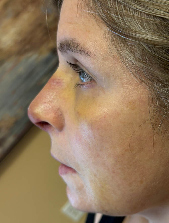 After Image: Patient Case #18687 - left-side