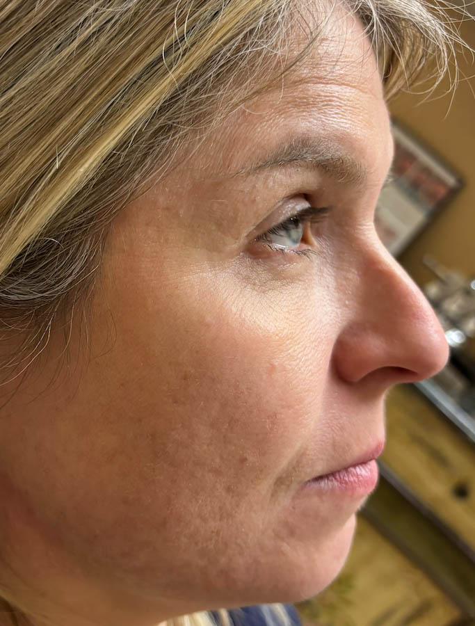 Before Image: Patient Case #18687 - right-side