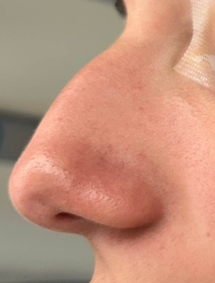 Before Image: Patient Case #18687 - left-side