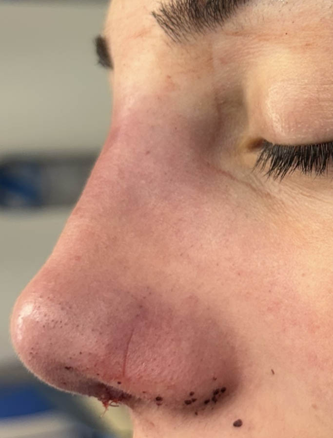 After Image: Patient Case #18687 - left-side