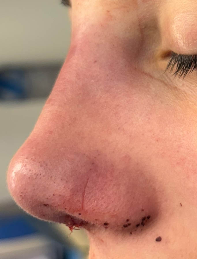 After Image: Patient Case #18687 - left-side