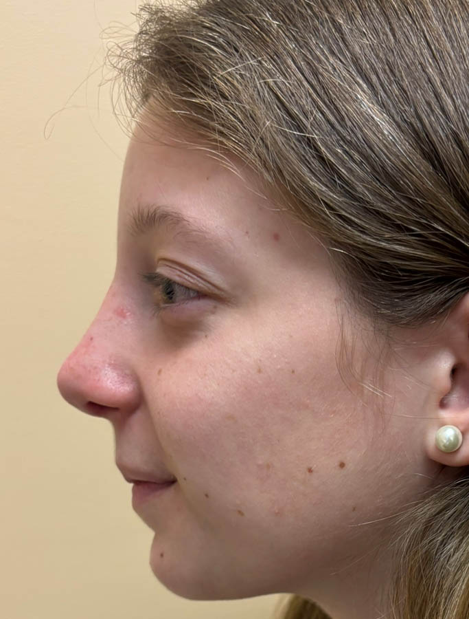 After Image: Patient Case #18892 - left-side