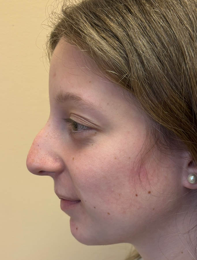 Before Image: Patient Case #18892 - left-side