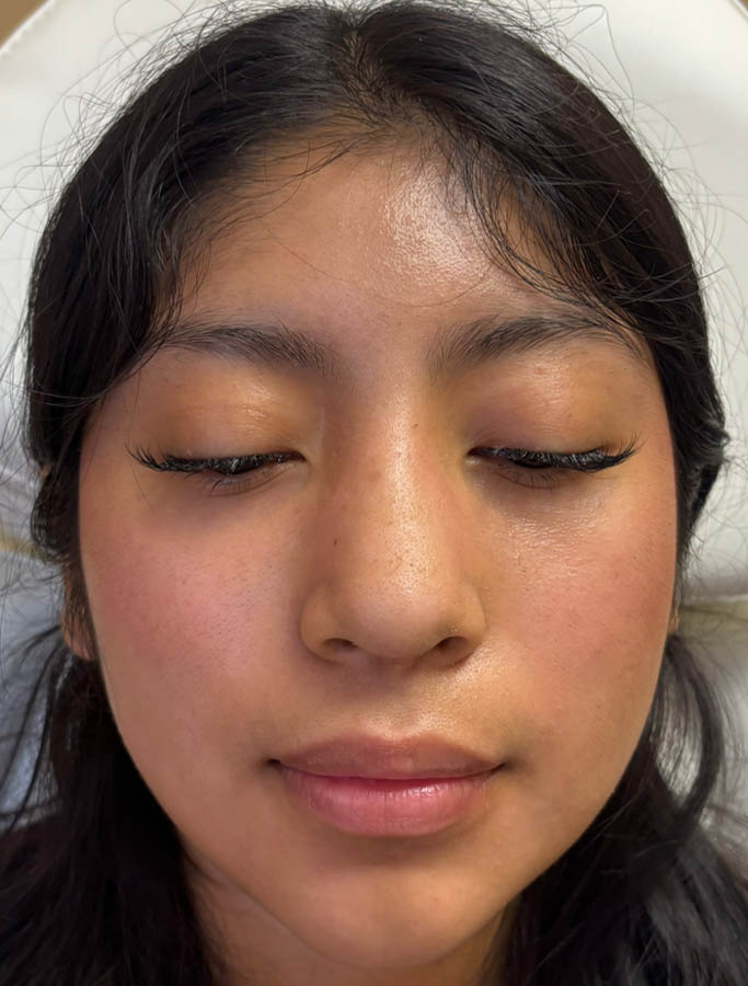 After Image: Patient Case #18914 - front