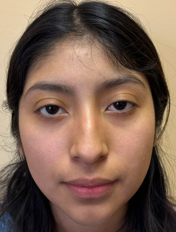 Before Image: Patient Case #18914 - front