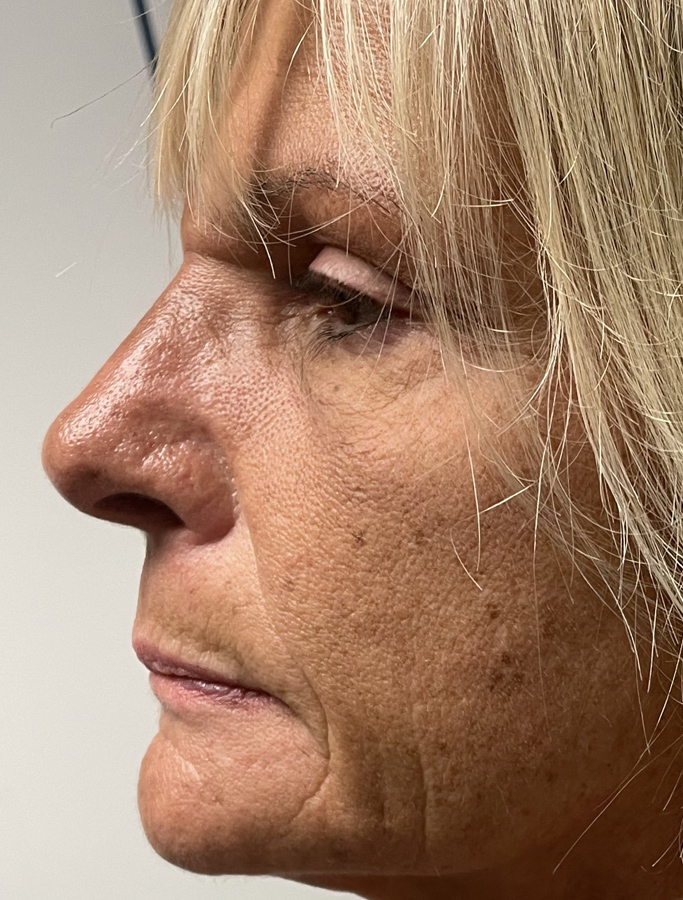 After Image: Patient Case #1892 - left-side