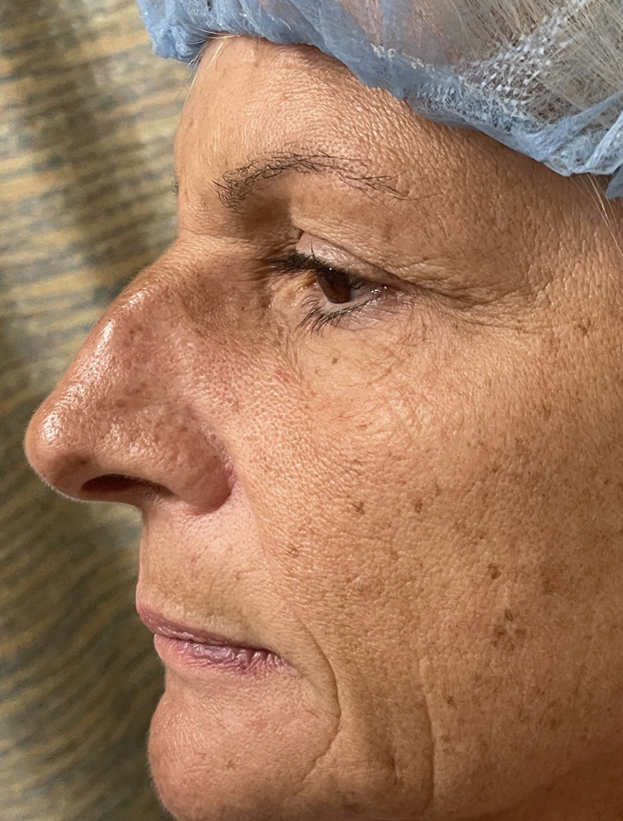 Before Image: Patient Case #1892 - left-side