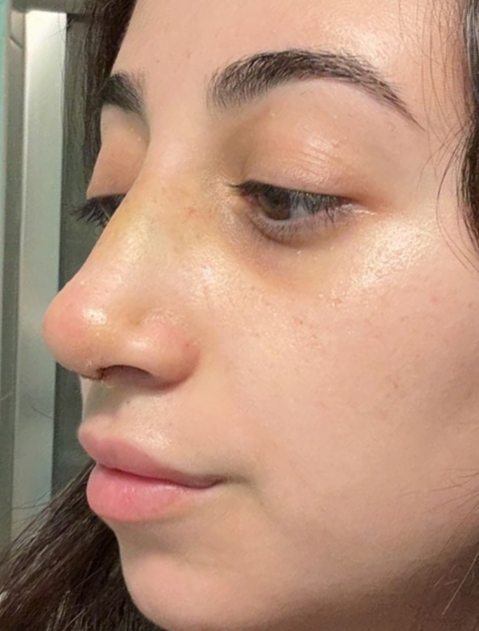 After Image: Patient Case #1975 - left-side