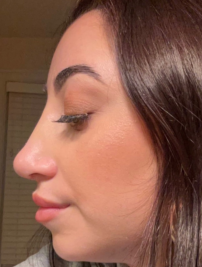 After Image: Patient Case #1975 - left-side