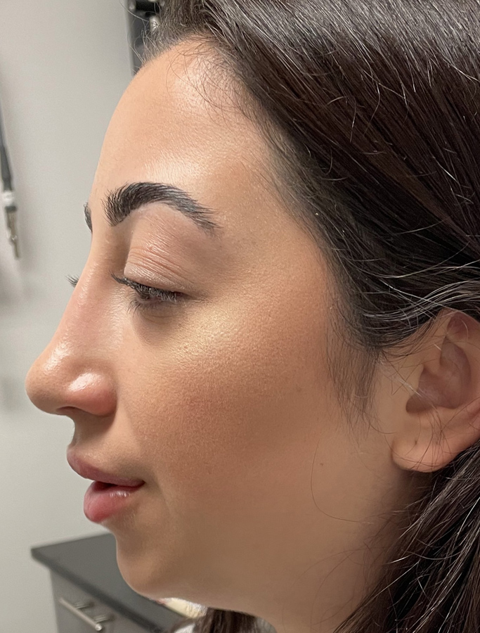 After Image: Patient Case #1975 - left-side