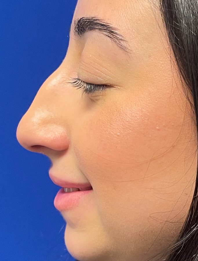 Before Image: Patient Case #1975 - left-side