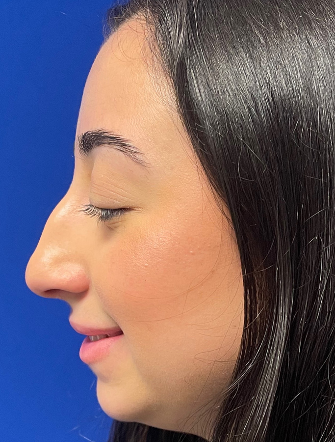 Before Image: Patient Case #1975 - left-side