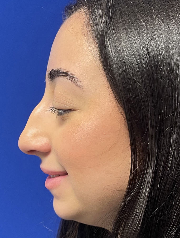 Before Image: Patient Case #1975 - left-side