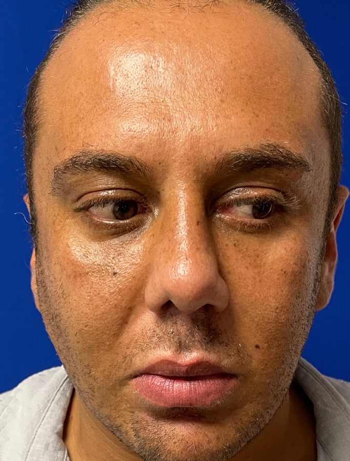 After Image: Patient Case #1985 - front