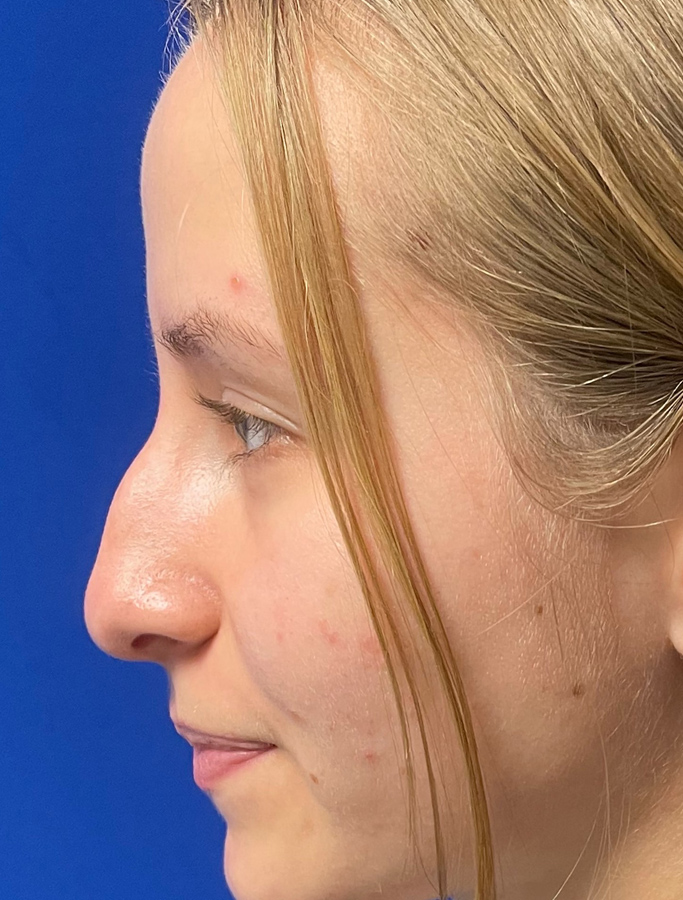 Before Image: Patient Case #1988 - left-side